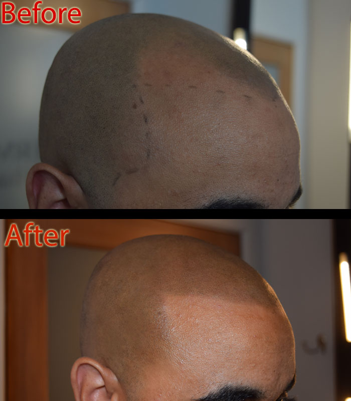 scalp micropigmentation SMP for covid-19 hair loss