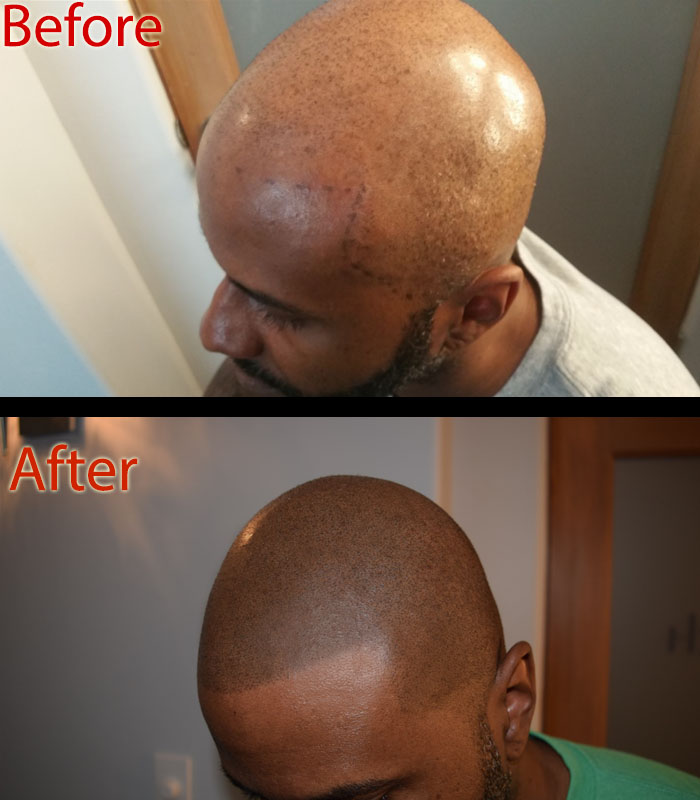 scalp micropigmentation SMP aftercare