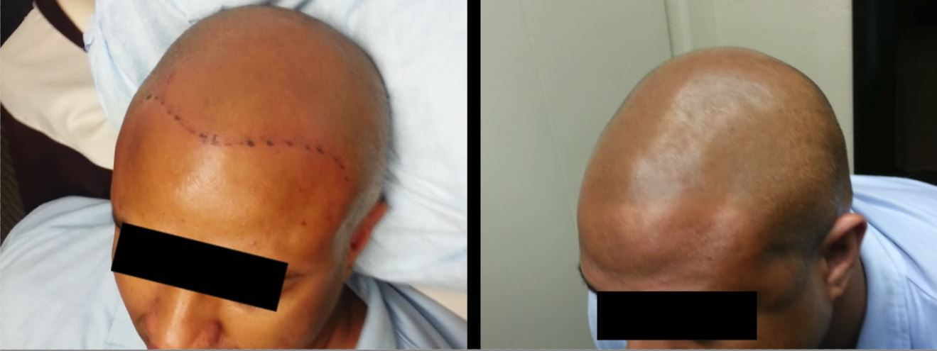 scalp micropigmentation SMP for baldness