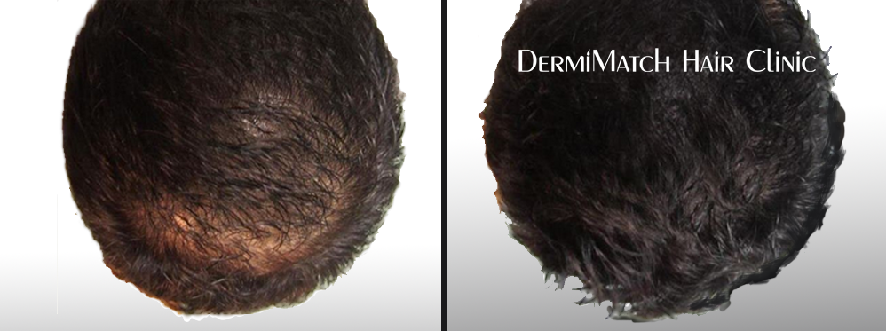 scalp micropigmentation SMP green tea and hair loss