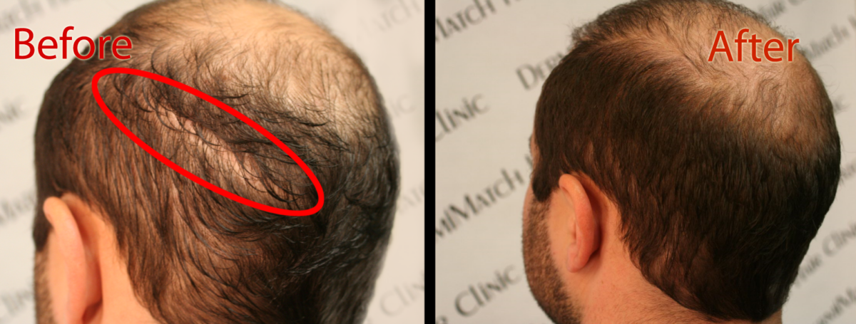 scalp micropigmentation SMP permanent solution to hair loss