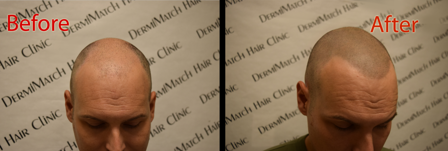 Hair Transplant Risks Why Avoid Surgery? DermiMatch Hair Clinic