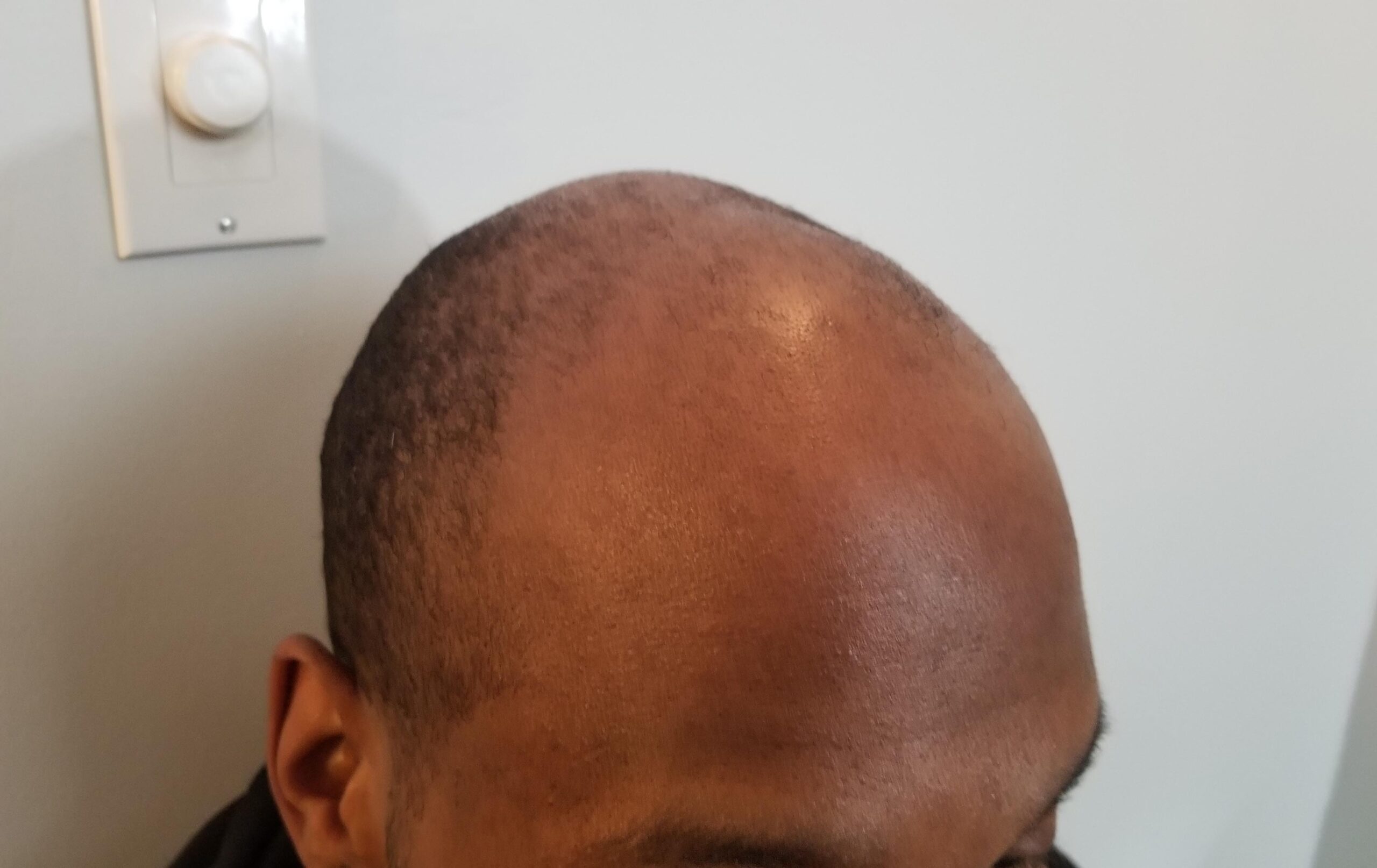 scalp micropigmentation SMP for hair loss