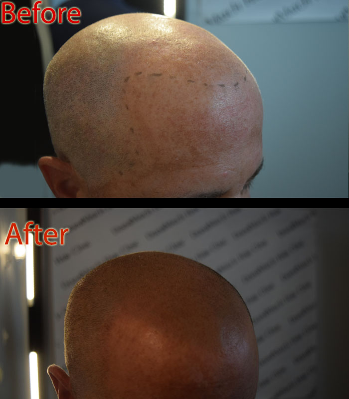 biotin vs scalp micropigmentation SMP for hair loss