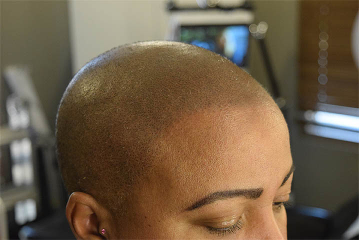 scalp micropigmentation smp for pcos hair loss