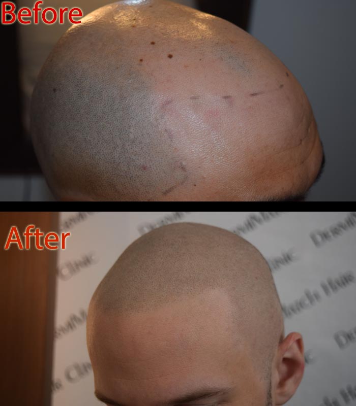 scalp micropigmentation SMP for loss of hair after chemotherapy