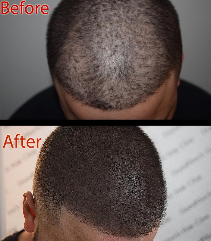 scalp micropigmentation SMP for gray hair