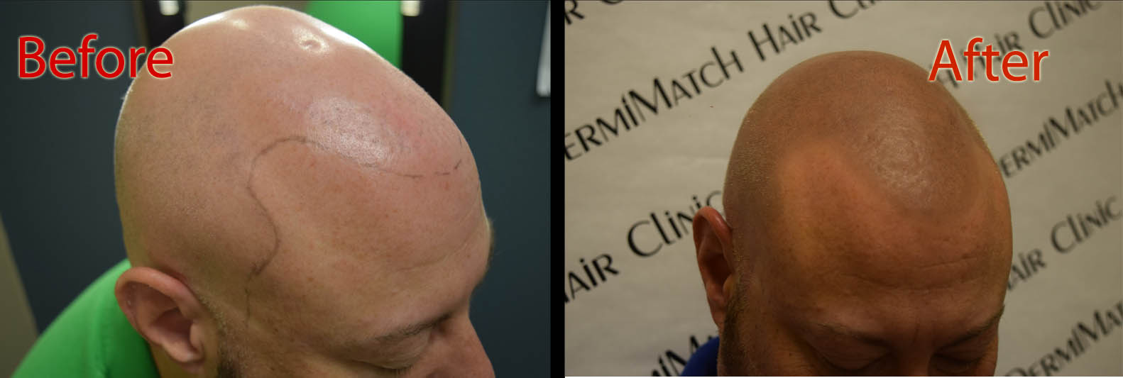 scalp micropigmentation SMP for visible scalp