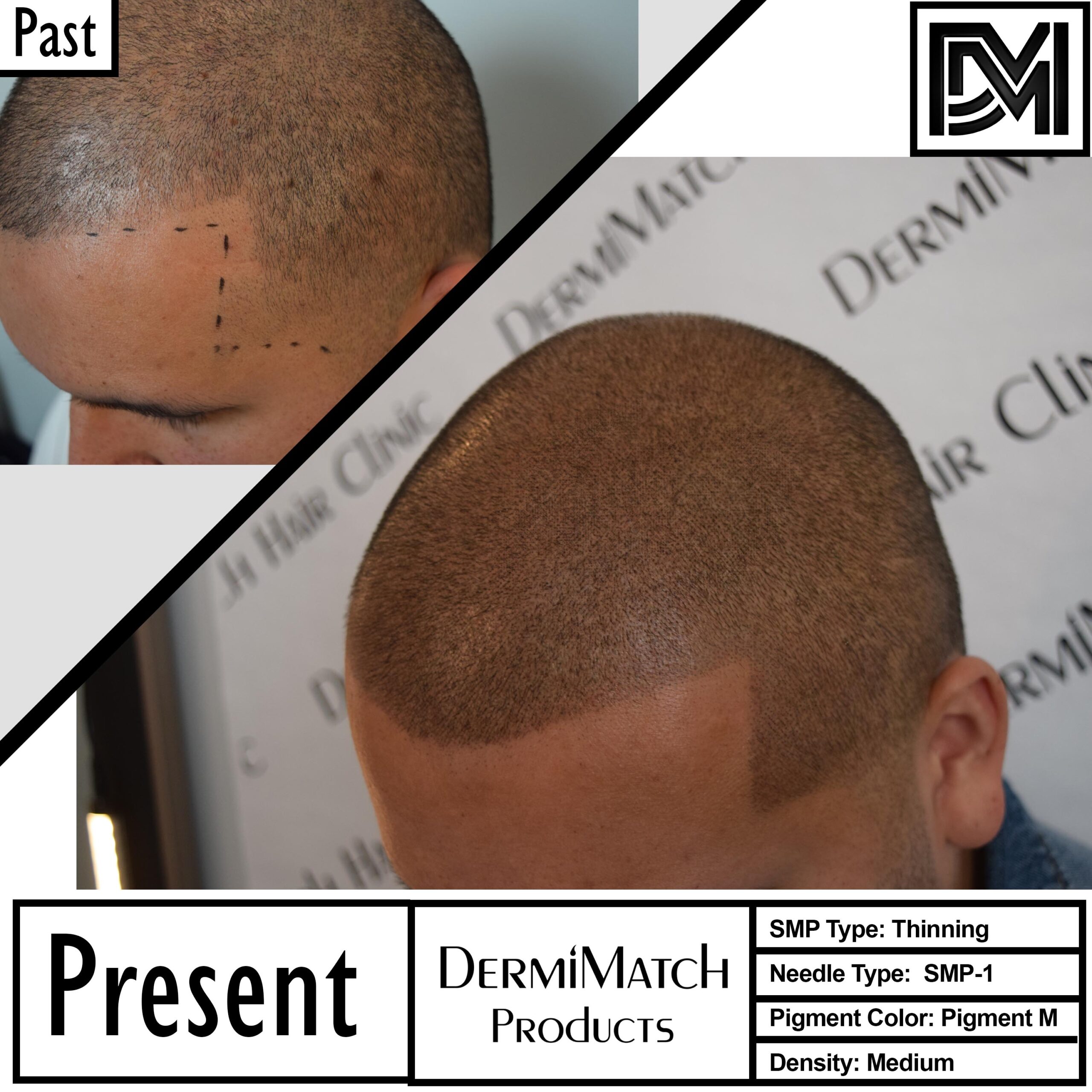 PRP versus scalp micropigmentation SMP