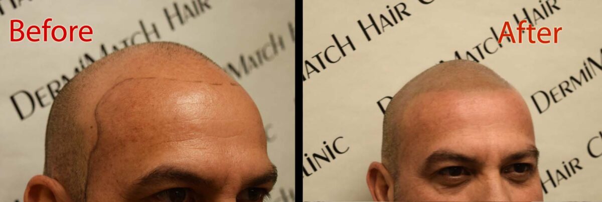 hair loss myths and scalp micropigmentation SMP