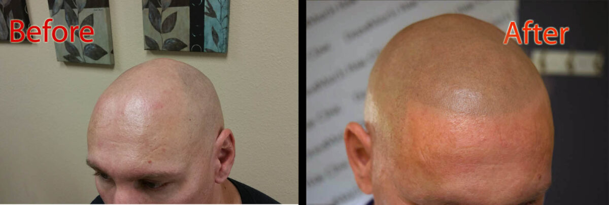 scalp micropigmentation SMP for covid-19 hair loss