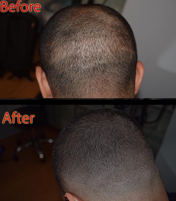 scalp micropigmentation SMP for hair growth