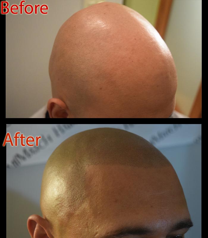 scalp micropigmentation SMP for chemotherapy hair loss