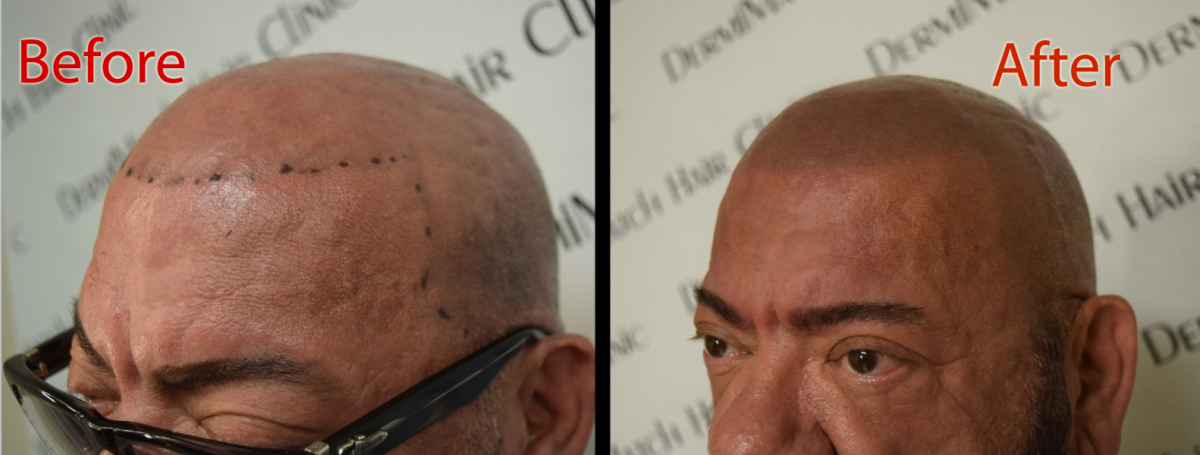 scalp micropigmentation SMP for hair density