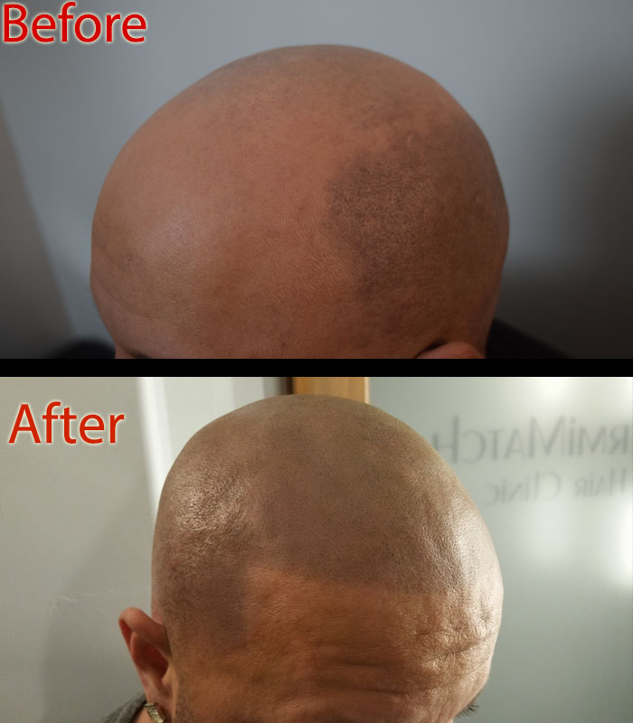 scalp micropigmentation SMP non-surgical hair loss treatment