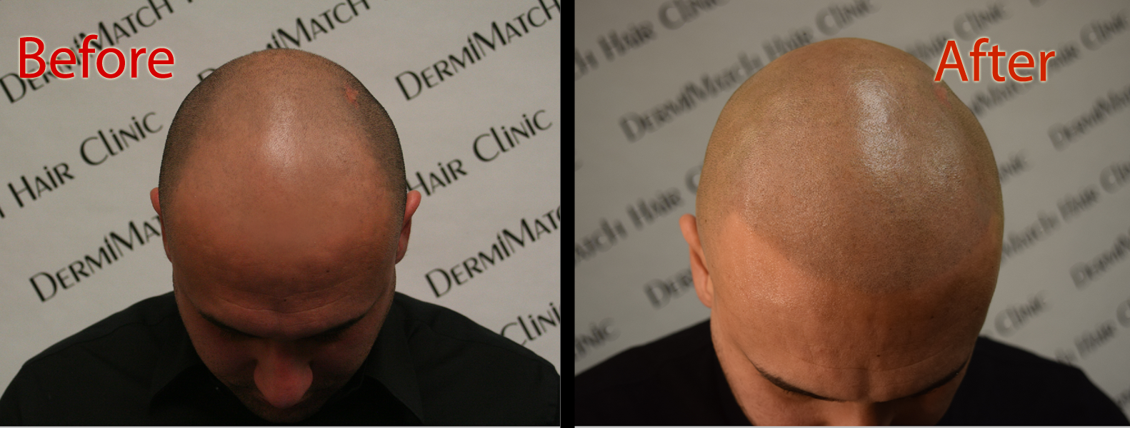 scalp micropigmentation smp for hair loss solution