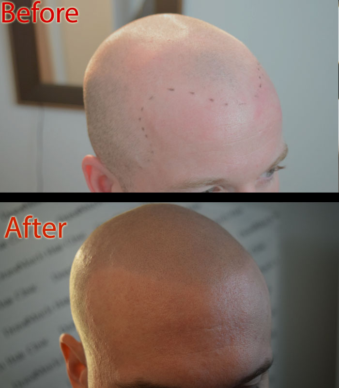 vitamins or scalp micropigmentation SMP for hair loss