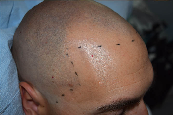 scalp micropigmentation SMP for baldness in men