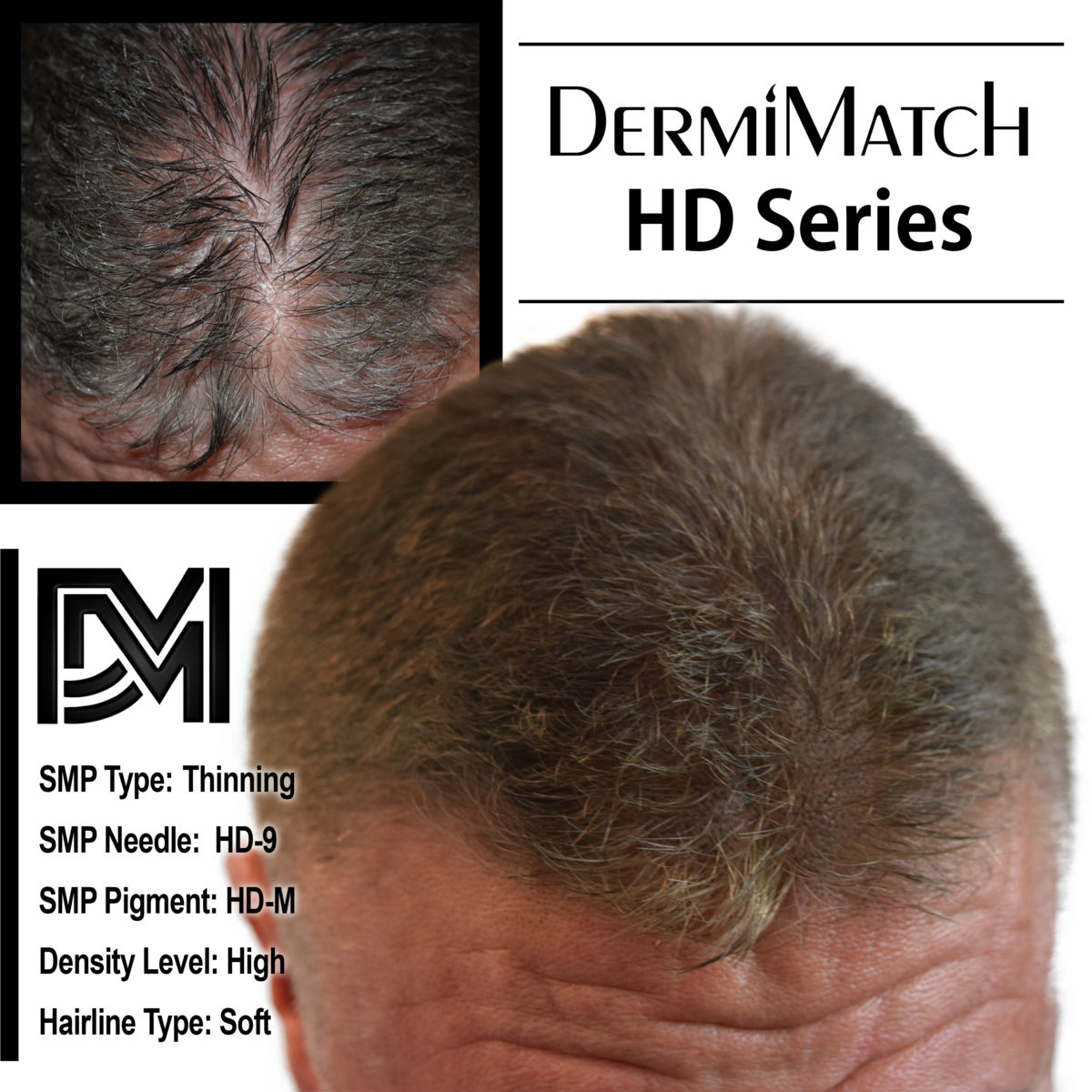 scalp micropigmentation SMP for hair loss