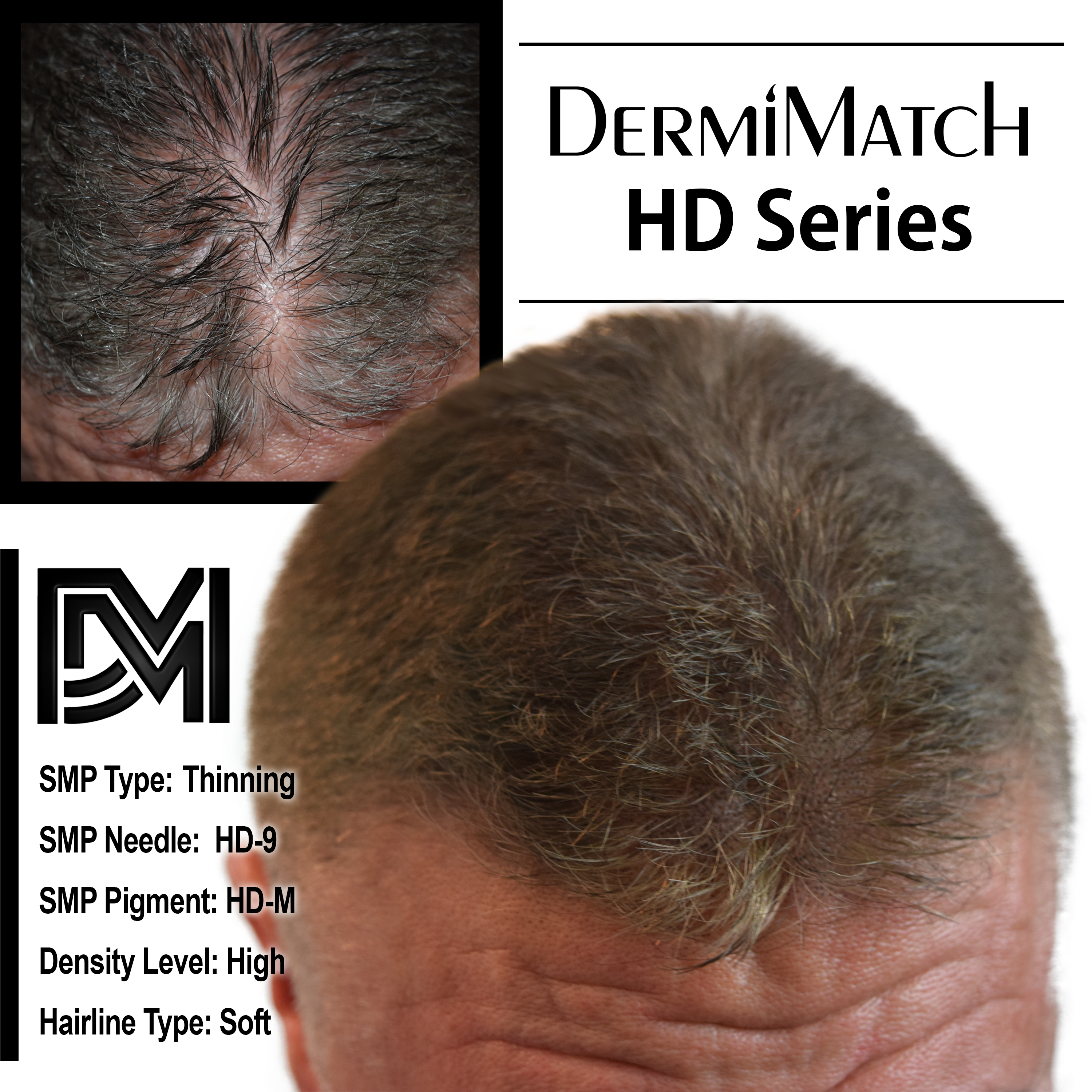 scalp micropigmentation SMP for hair loss