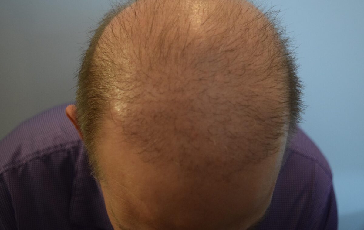 scalp micropigmentation SMP for receding hairline