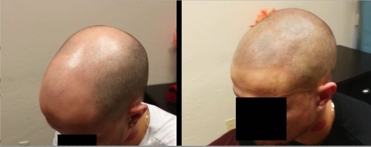 scalp micropigmentation SMP for circular hair loss