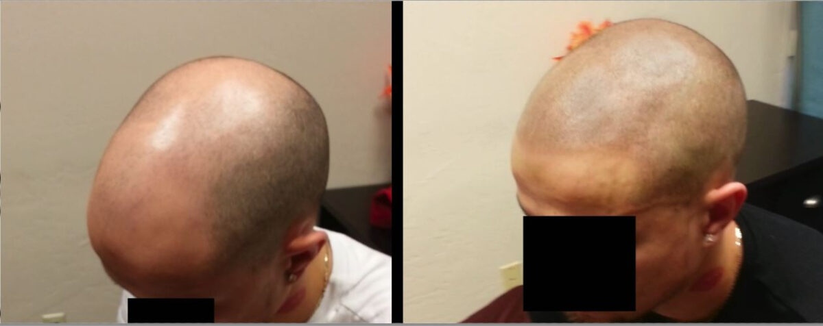 scalp micropigmentation SMP in one day