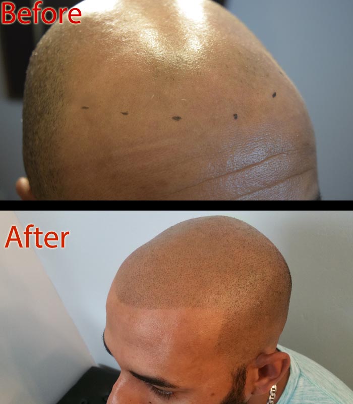 scalp micropigmentation SMP for bald head care