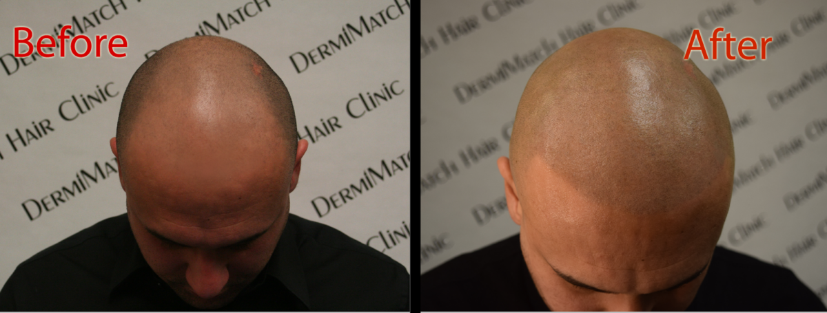 scalp micropigmentation SMP in Arizona better than hair fillers