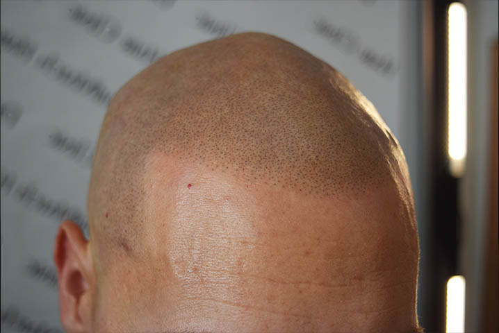 shaving after scalp micropigmentation SMP