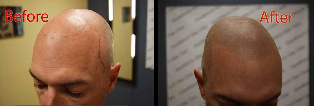 scalp micropigmentation SMP for seasonal hair loss