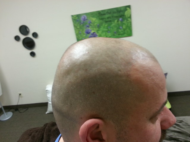 scalp micropigmentation SMP and hair loss