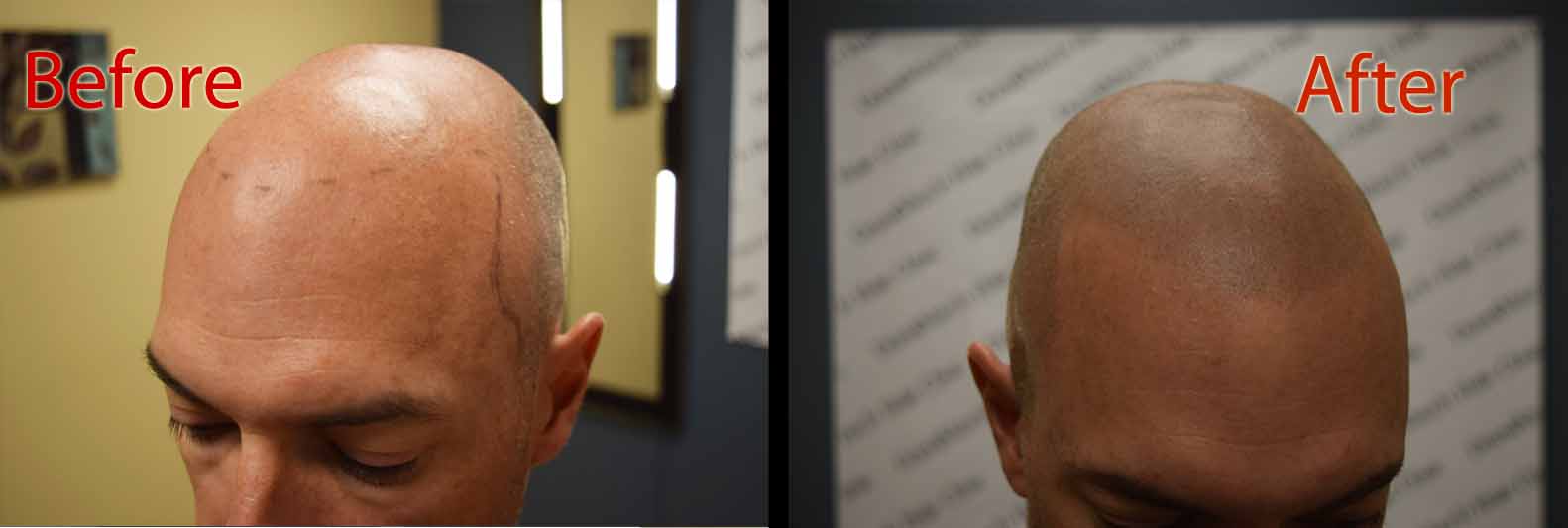 scalp micropigmentation SMP for hair loss