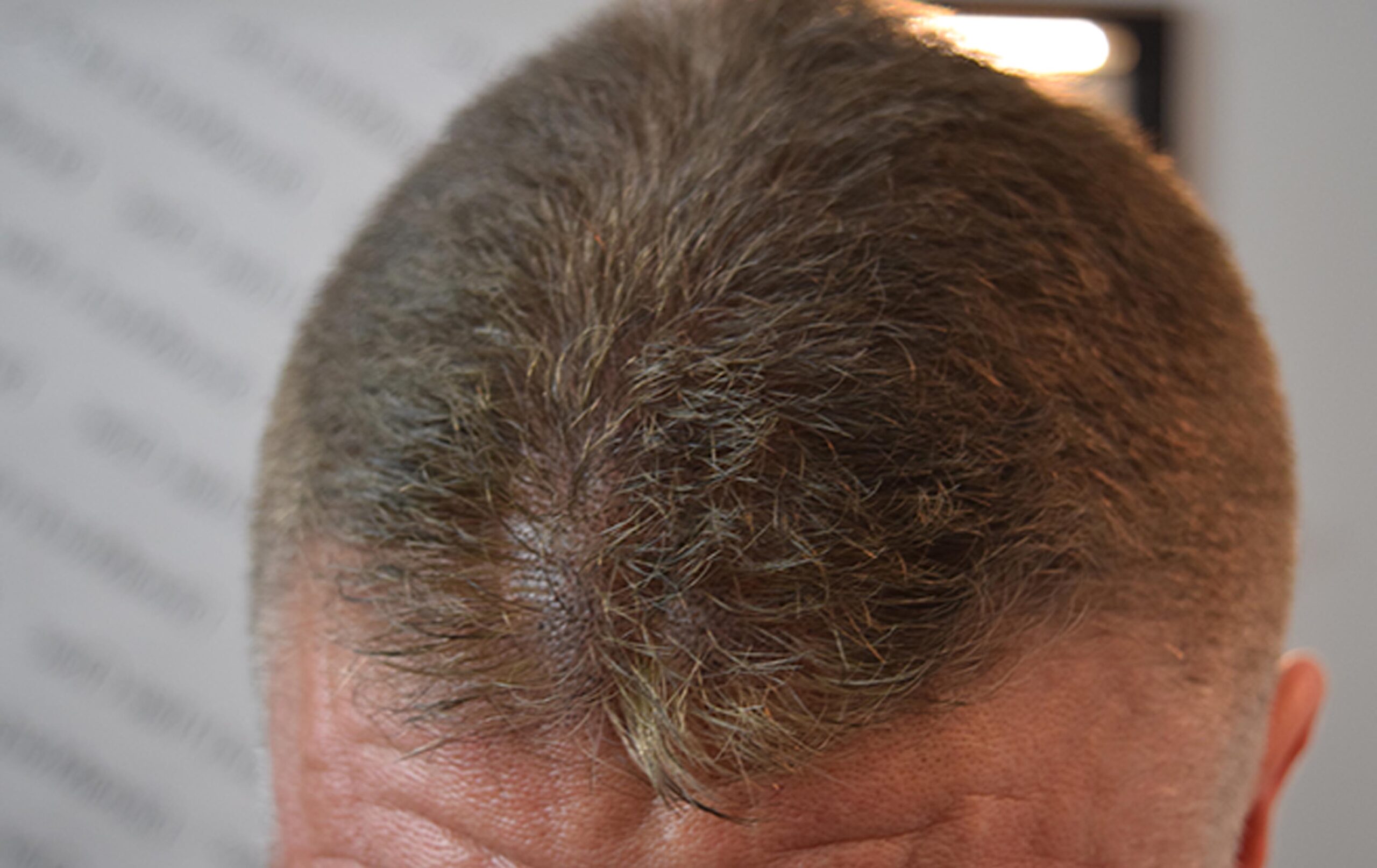 scalp micropigmentation SMP hair loss