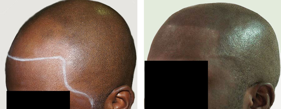 scalp micropigmentation SMP for smoking induced hair loss