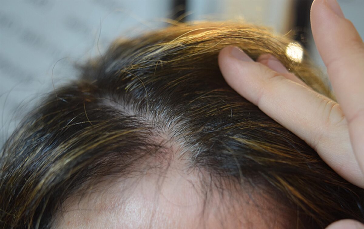 scalp micropigmentation smp for hair thinning in women