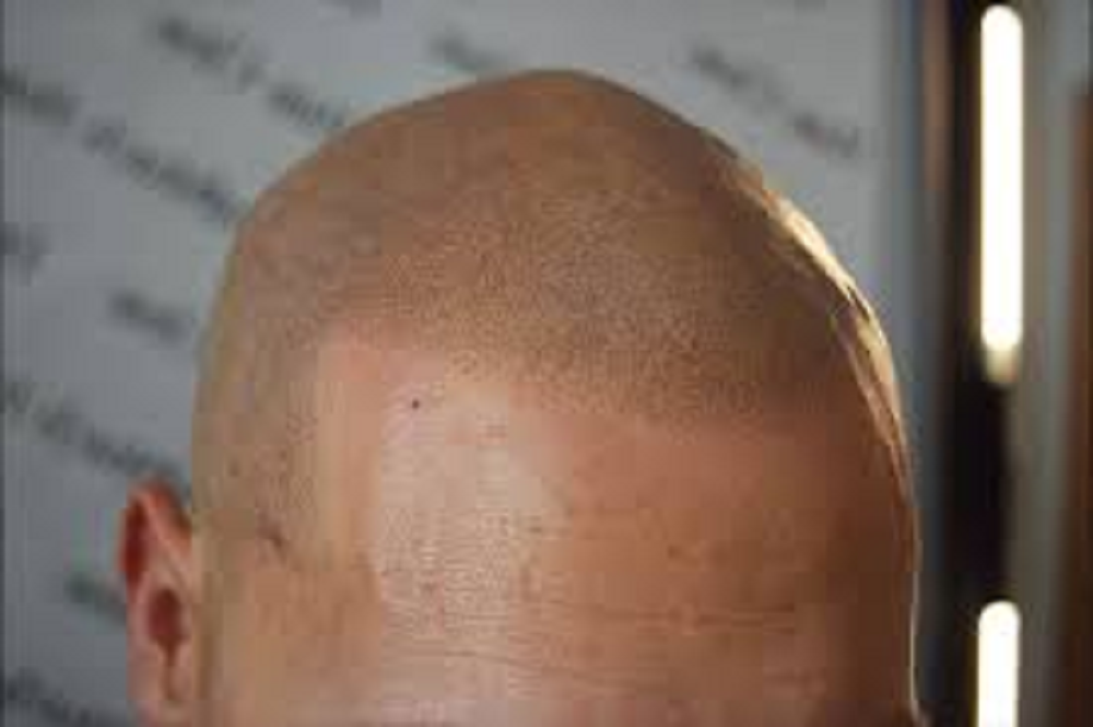 scalp micropigmentation SMP for hair loss