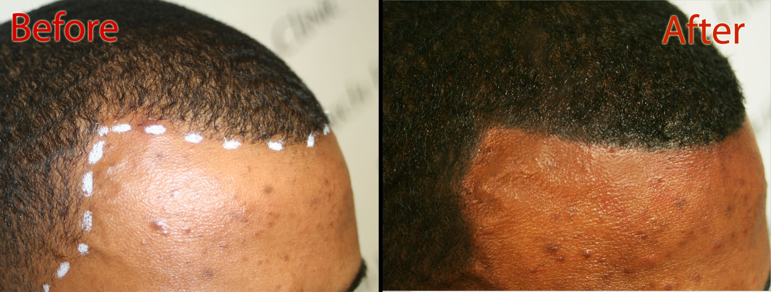 scalp micropigmentation SMP for creatine hair loss in Scottsdale
