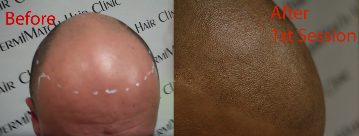 scalp micropigmentation SMP for hair loss