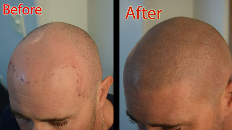 dht hair loss and scalp micropigmentation SMP in Arizona