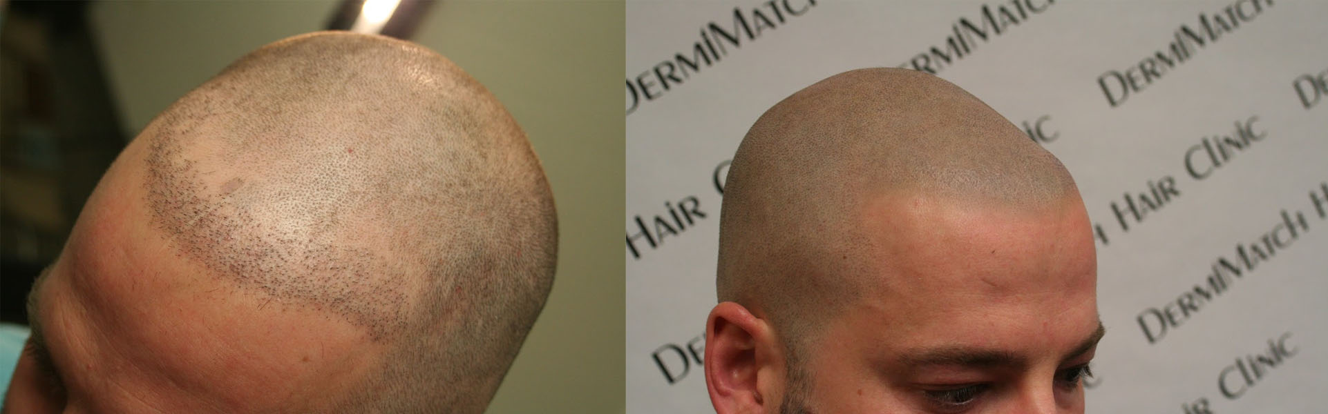 scalp micropigmentation SMP for male pattern baldness in Phoenix