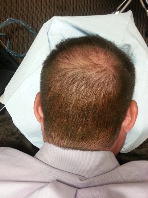 scalp micropigmentation smp hair loss in Arizona