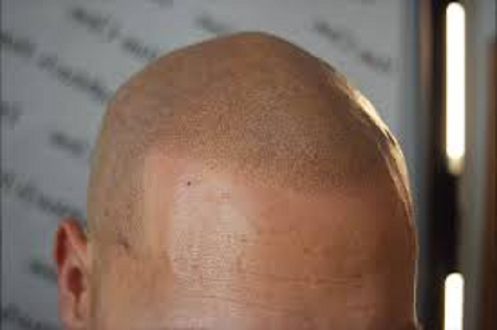 scalp micropigmentation SMP for hair growth in Phoenix