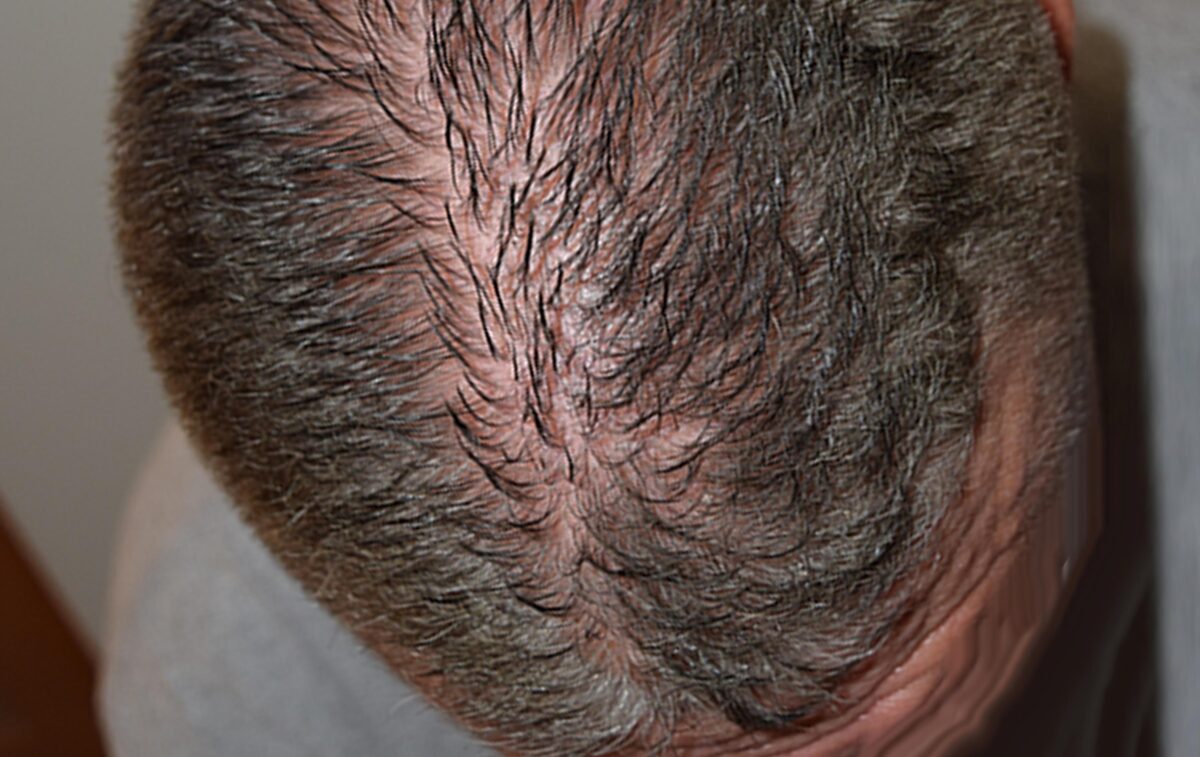scalp micropigmentation smp in arizona