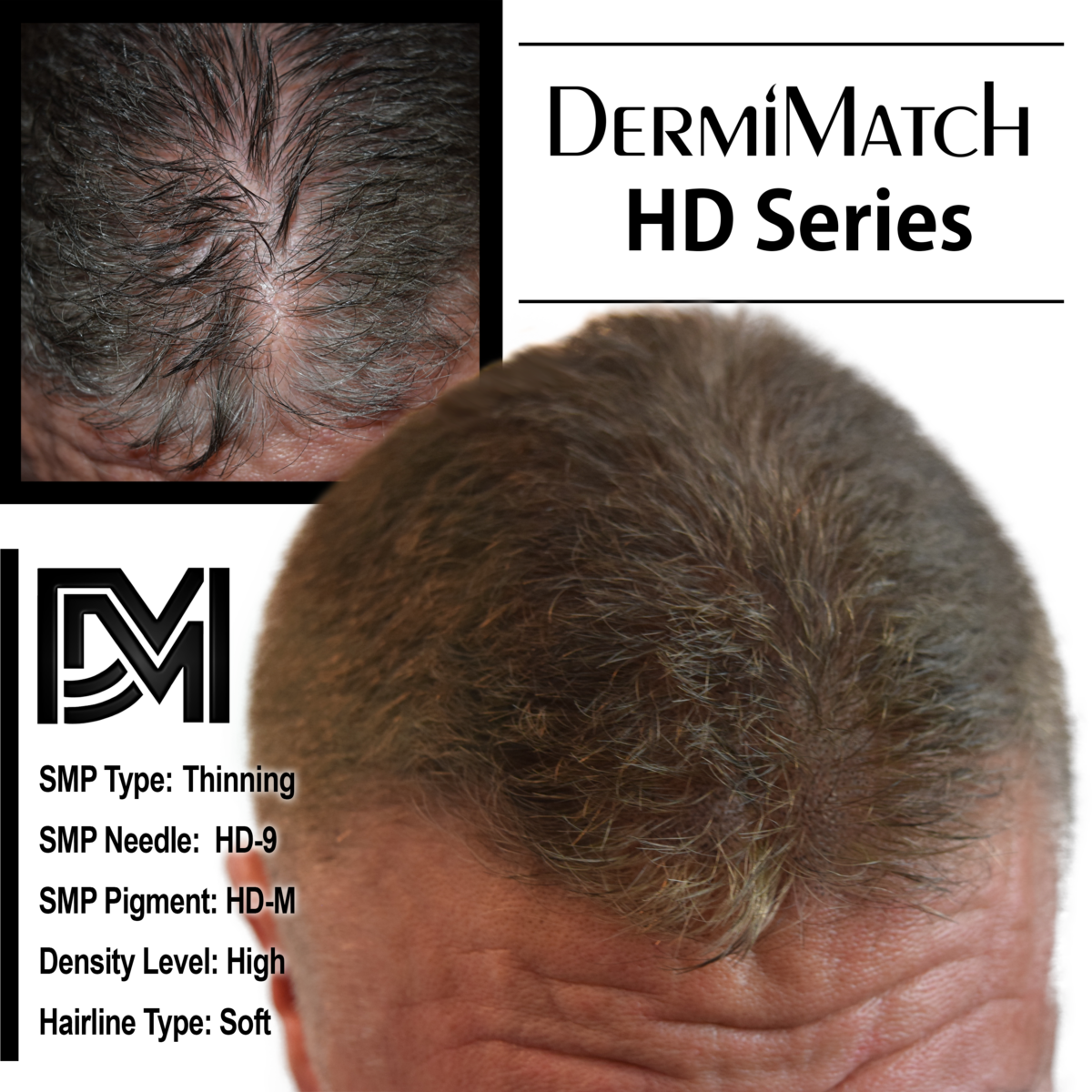 scalp micropigmentation SMP for androgenetic alopecia in Arizona