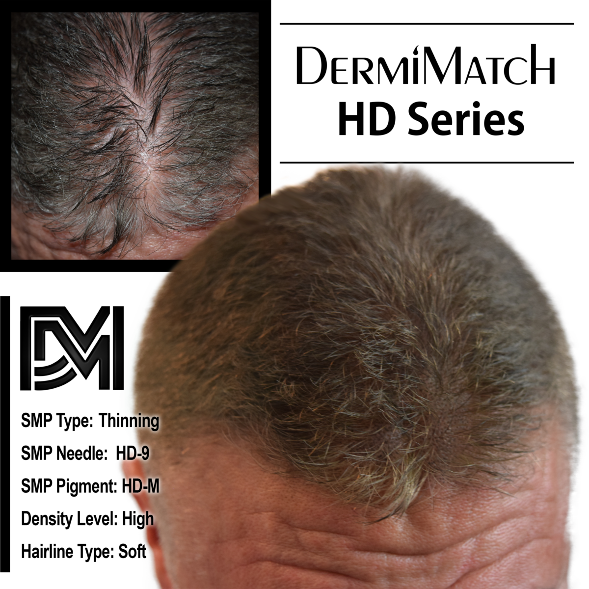 scalp micropigmentation SMP for androgenetic alopecia in Arizona