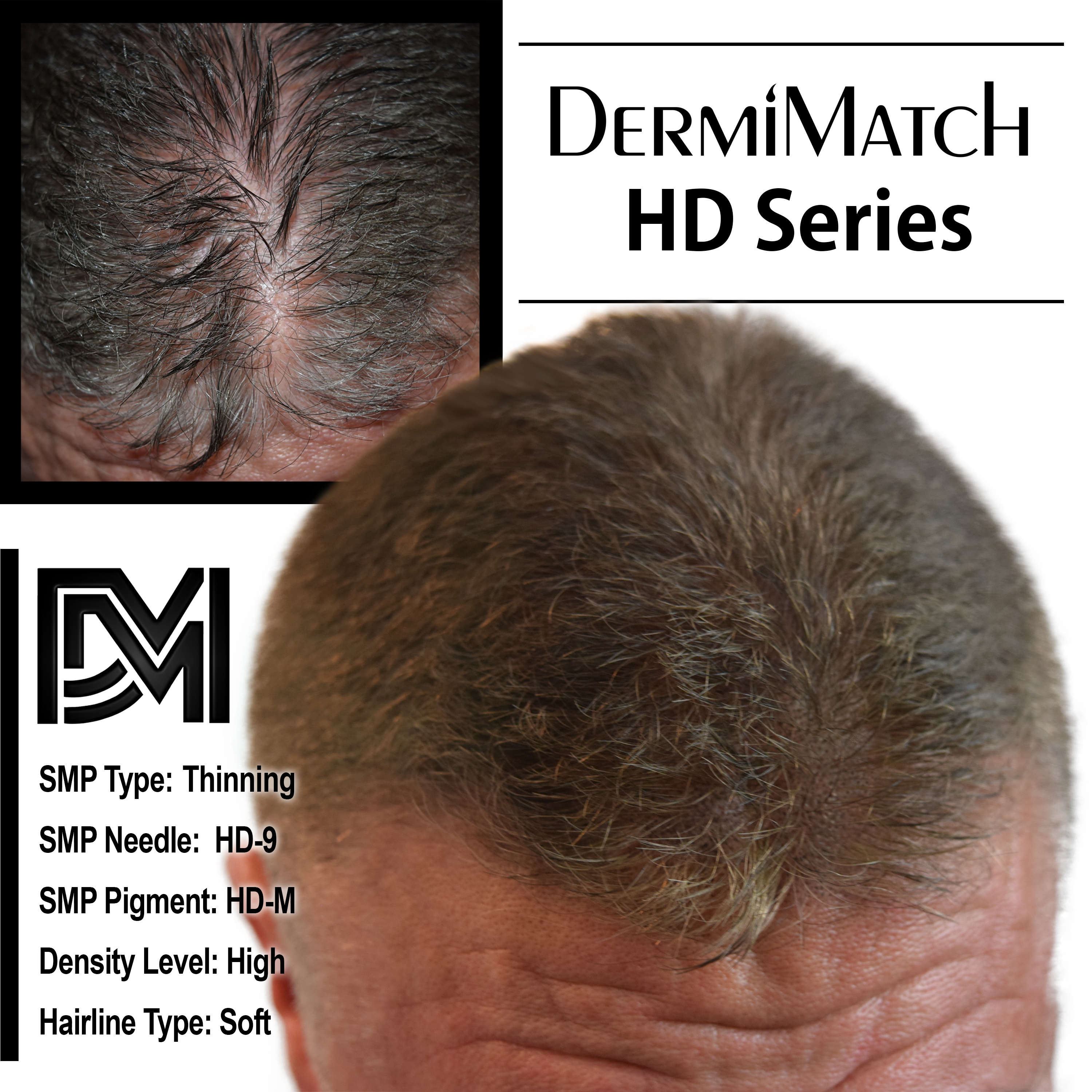 scalp micropigmentation SMP for androgenetic alopecia in Arizona
