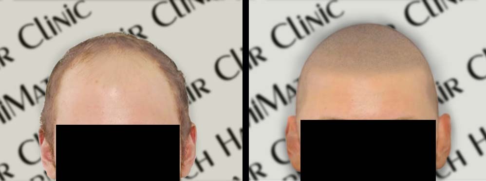 scalp micropigmentation smp in arizona