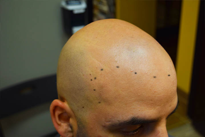 scalp micropigmentation SMP in phoenix