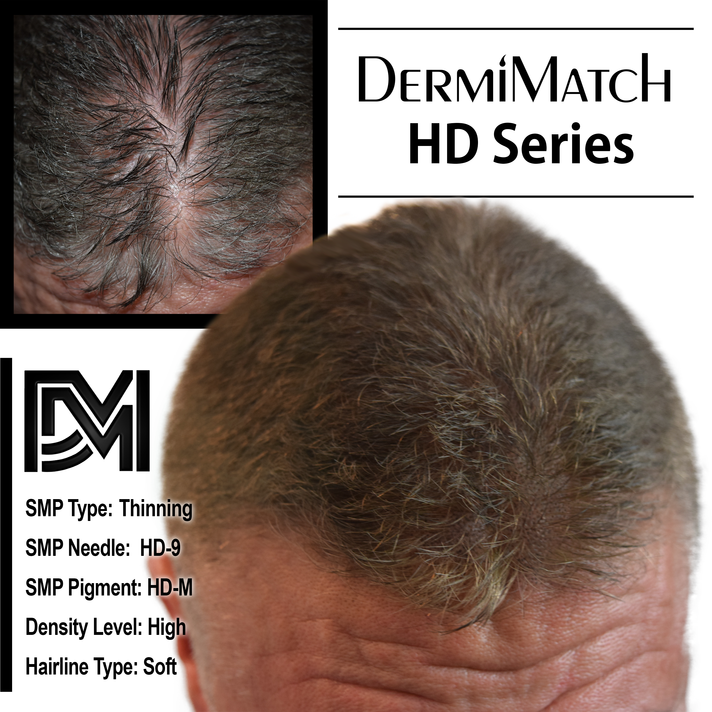 scalp micropigmentation SMP in Arizona